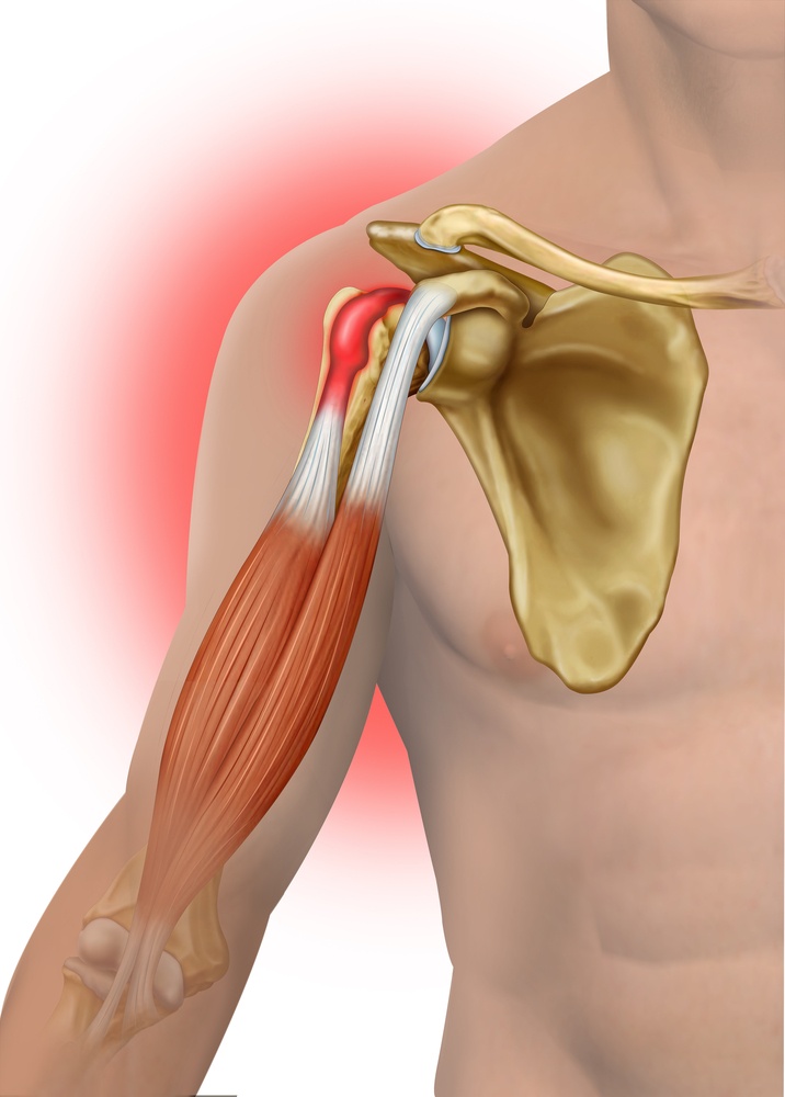 Read more about the article Bóle przodu barku – zapalenie ścięgna głowy długiej bicepsa